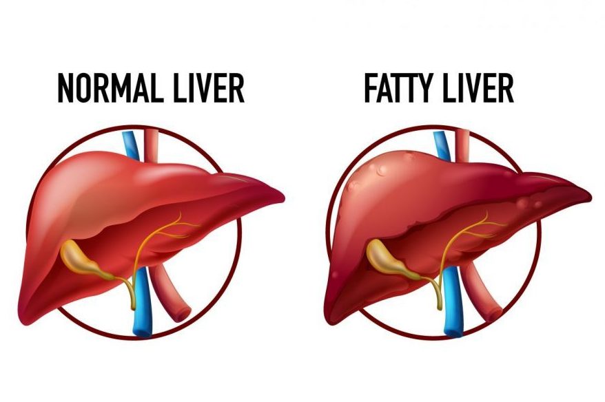 फैटी लिवर के लक्षण - Symptoms of Fatty Liver in Hindi 