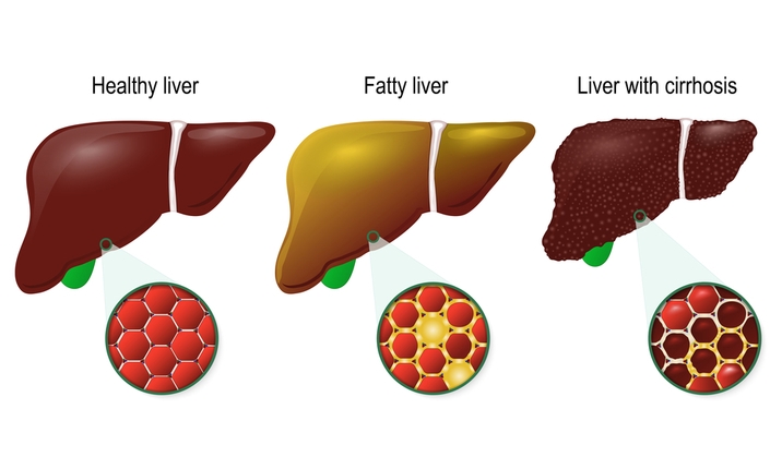 फैटी लिवर के इलाज और उपाय - Treatment and Remedies of Fatty Liver in Hindi 