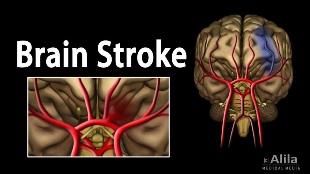 ब्रेन स्ट्रोक के कारण - Causes of Brain Stroke in Hindi 